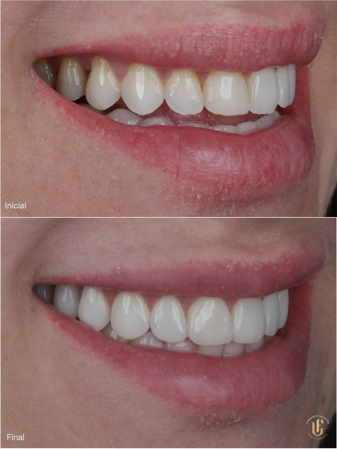 Transformação Sculpt Face